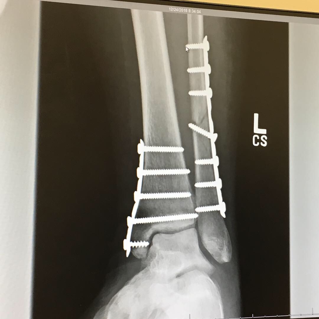 X-ray of leg and ankle showing a metal plate on each side and lots of screws
