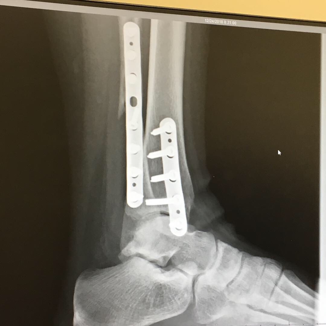 Side view X-ray that shows the plates holding my leg and ankle together. 